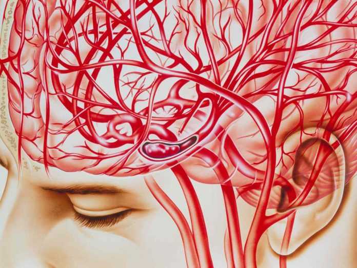 Vasos sanguíneos que pueden verse afectados por un derrame cerebral


